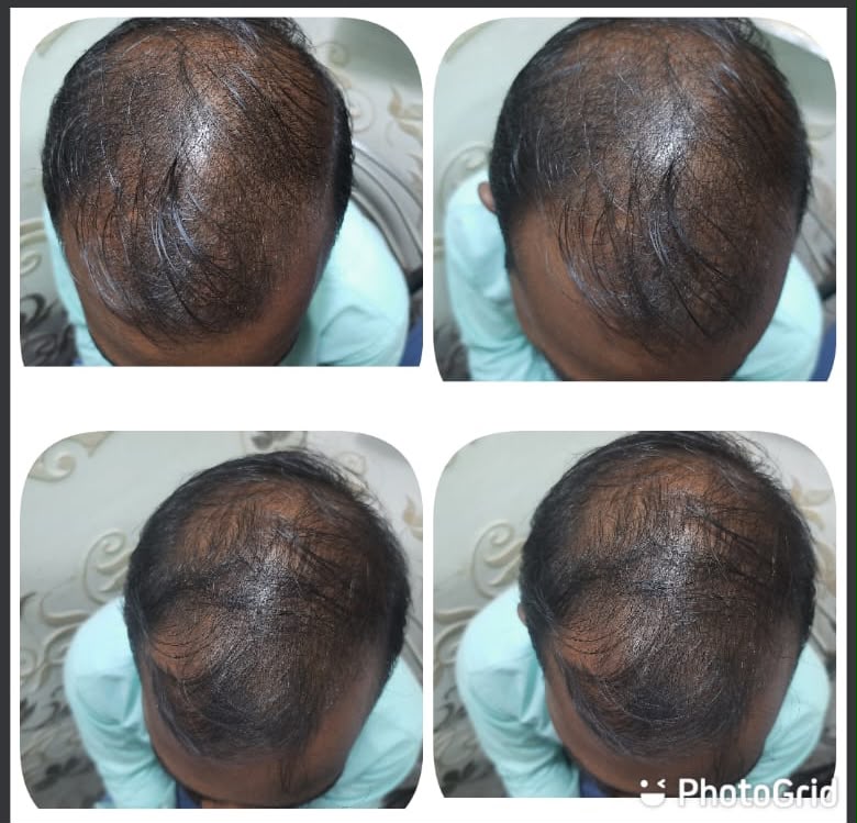 Hair thinning client case photos