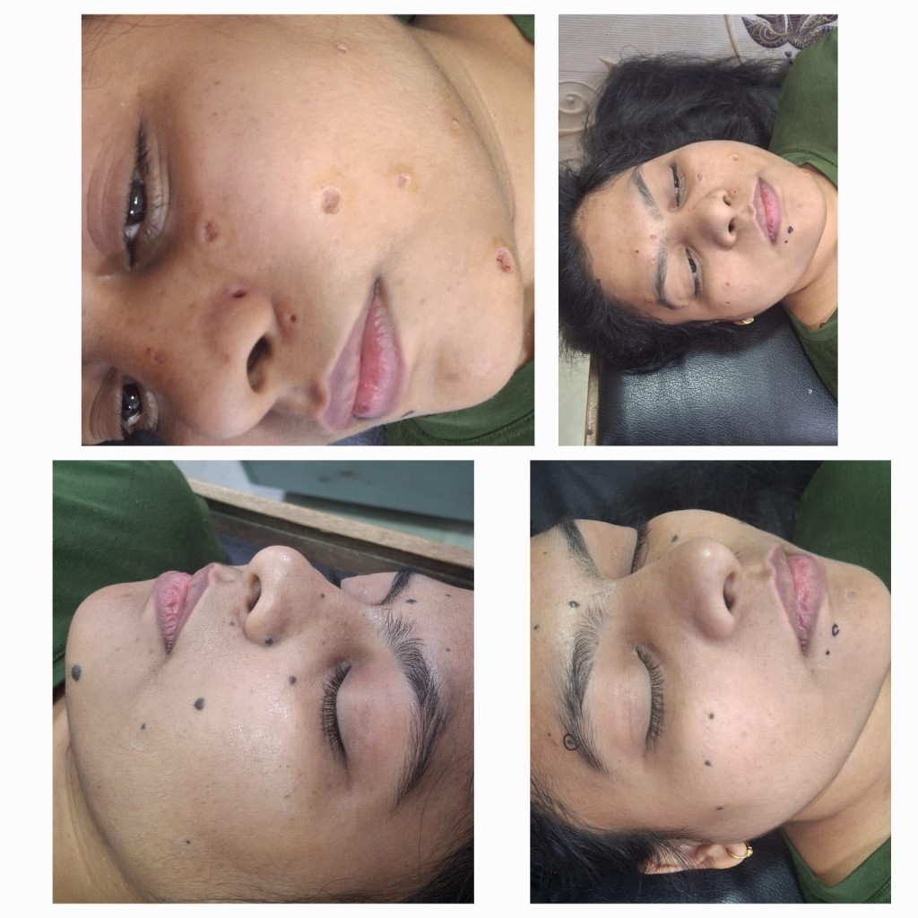 Mole care tips