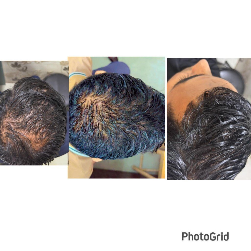 Male pattern baldness before and after PRP treatment sessions
