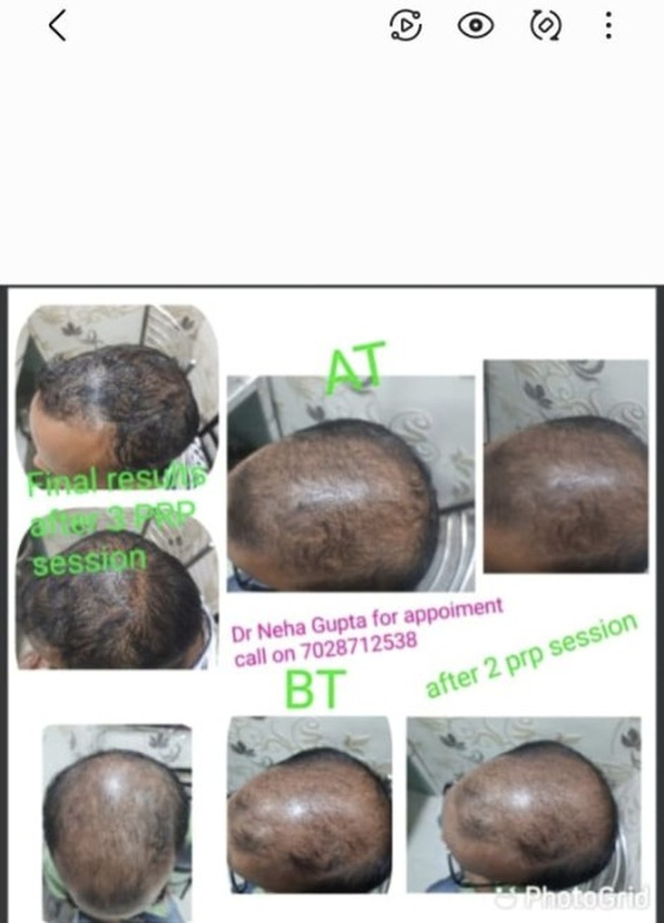 PRP treatment before and after three sessions